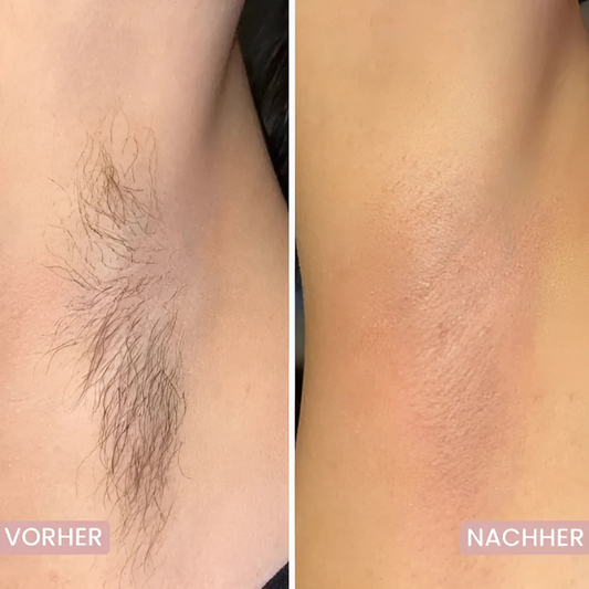 5-in-1 Haarentferner – Glatte Haut ohne Schnitte