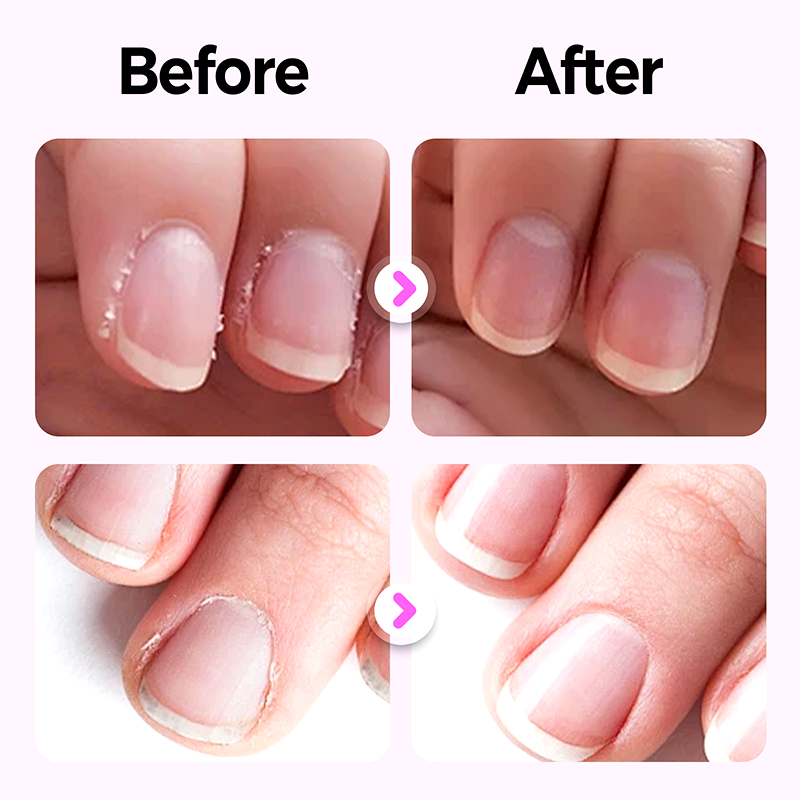 💜 3-w-1 pióro do pielęgnacji paznokci [Kup 1 i otrzymaj 2 gratis]💅